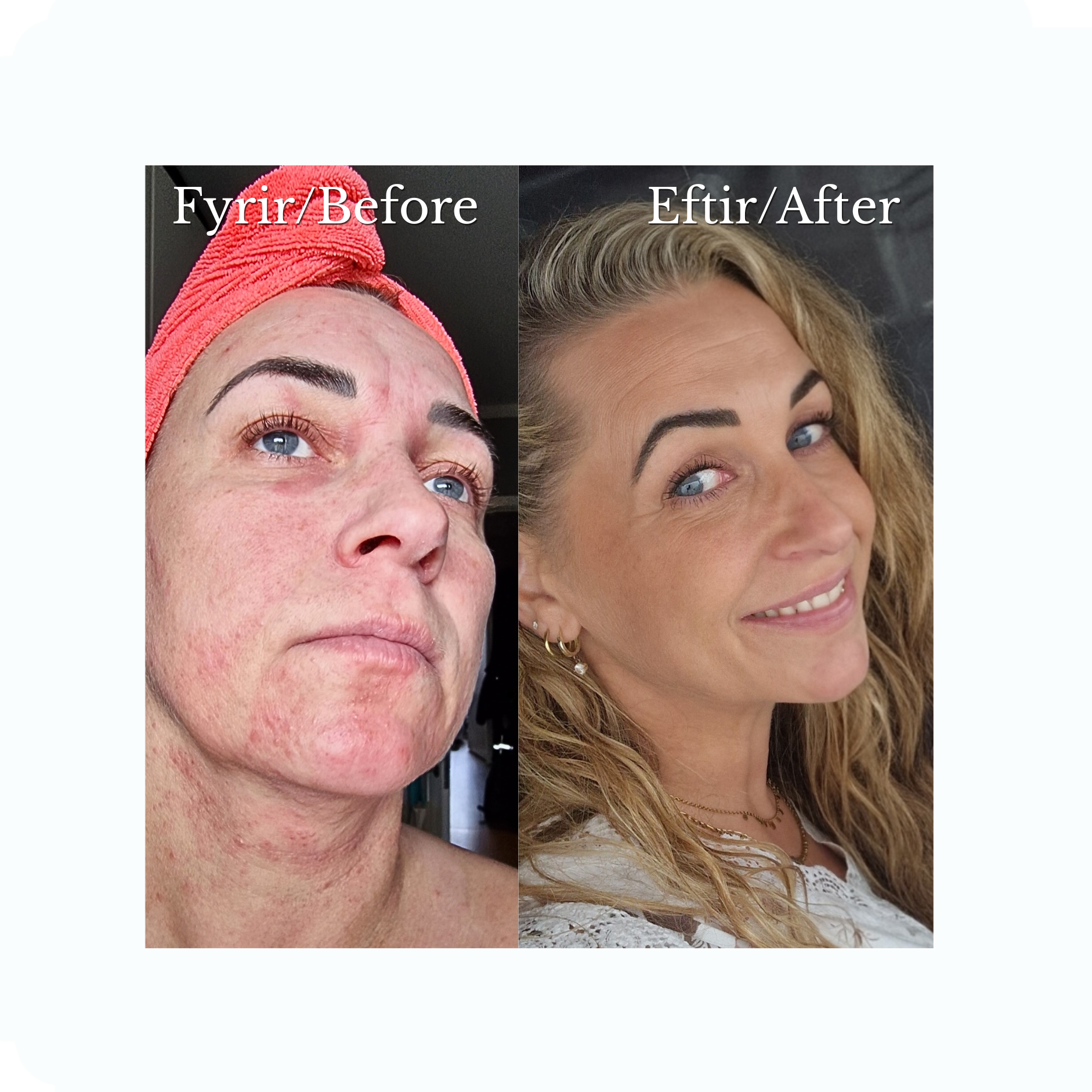 Áralangt baráttuferli - Fann loksins vörur sem virka