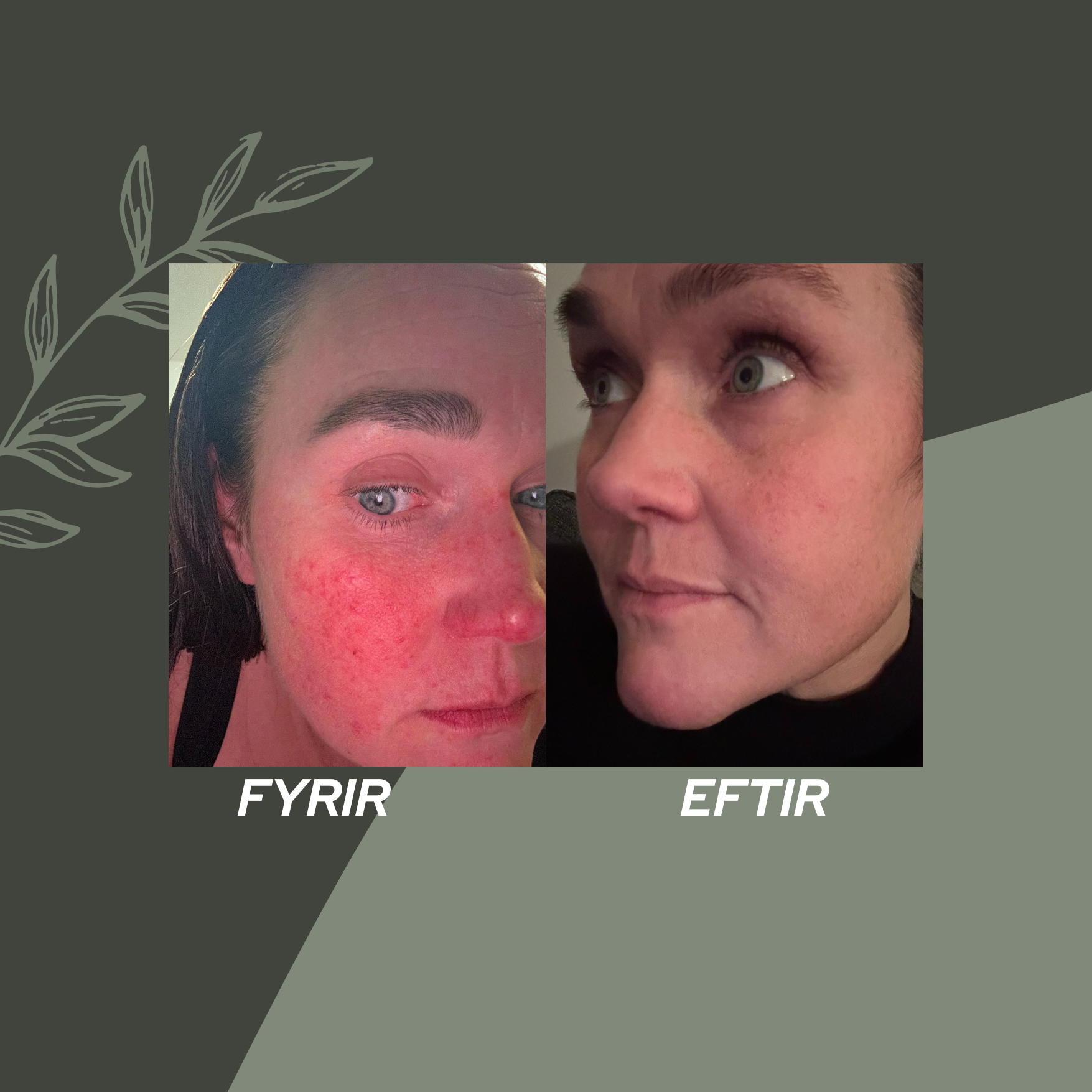 Stórmunur á rósroða eftir mánaðar notkun!